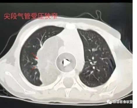 影像PPT - 【病例】幼儿脂肪母细胞瘤1例CT影像-46