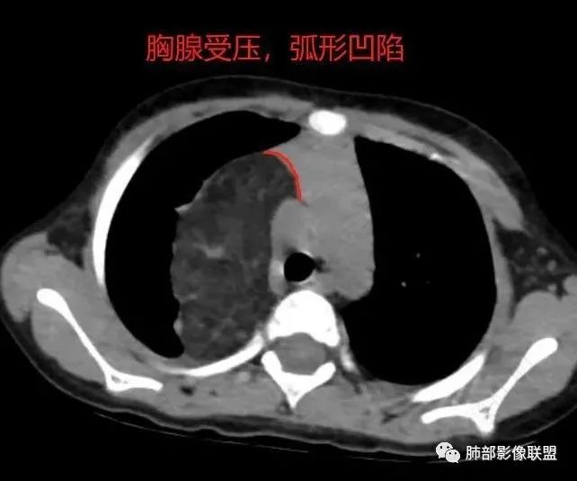 影像PPT - 【病例】幼儿脂肪母细胞瘤1例CT影像-51