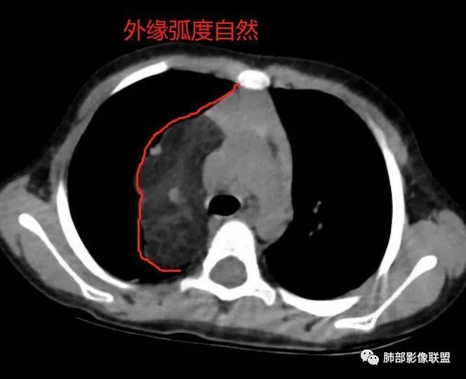 影像PPT - 【病例】幼儿脂肪母细胞瘤1例CT影像-52
