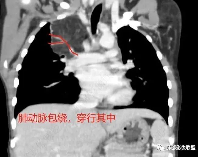影像PPT - 【病例】幼儿脂肪母细胞瘤1例CT影像-53