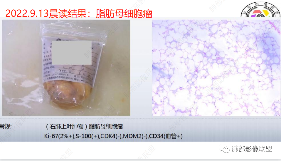 影像PPT - 【病例】幼儿脂肪母细胞瘤1例CT影像-58