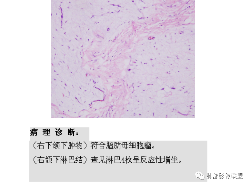 影像PPT - 【病例】幼儿脂肪母细胞瘤1例CT影像-60