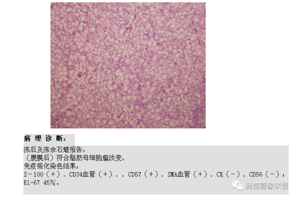 影像PPT - 【病例】幼儿脂肪母细胞瘤1例CT影像-62