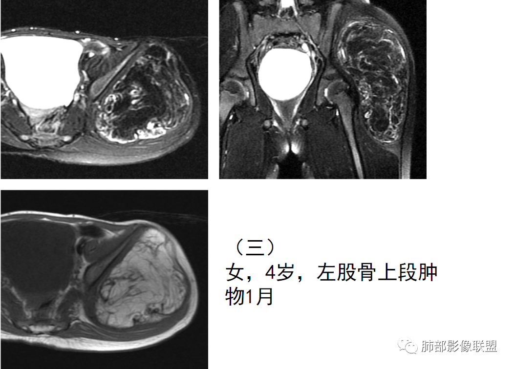 影像PPT - 【病例】幼儿脂肪母细胞瘤1例CT影像-63