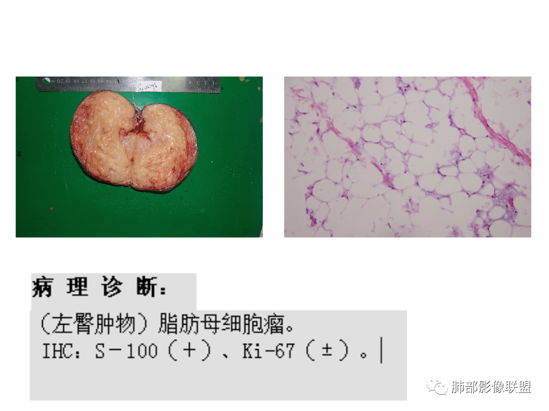 影像PPT - 【病例】幼儿脂肪母细胞瘤1例CT影像-64
