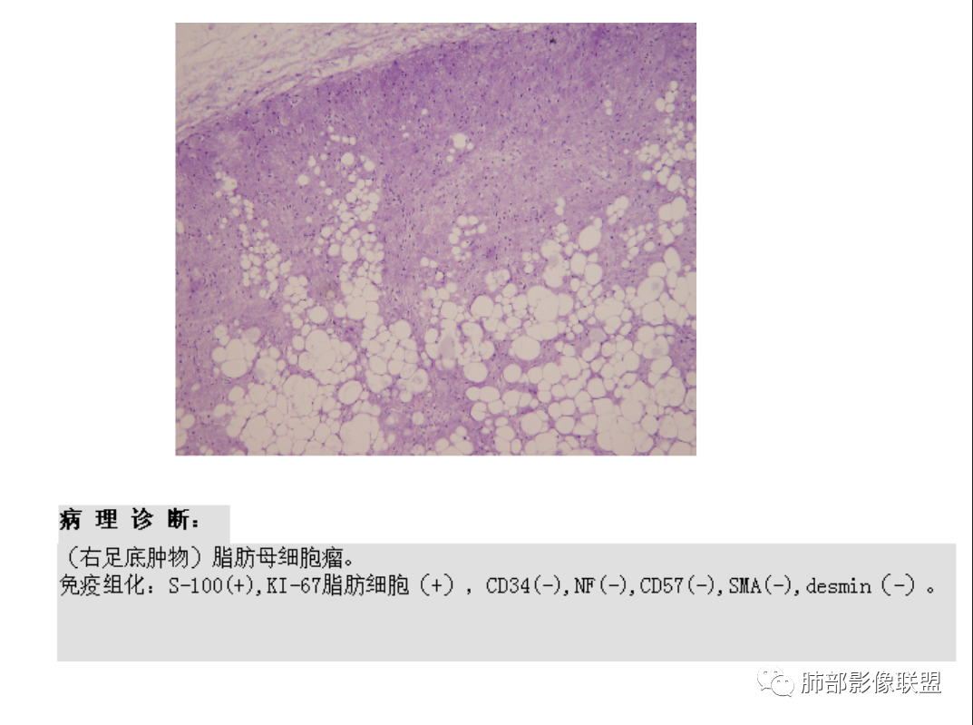 影像PPT - 【病例】幼儿脂肪母细胞瘤1例CT影像-66