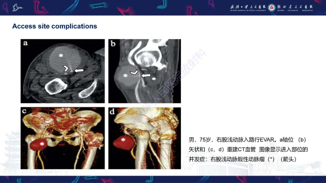影像PPT - 【PPT】腹主动脉瘤EVAR术后并发症CT评估-8