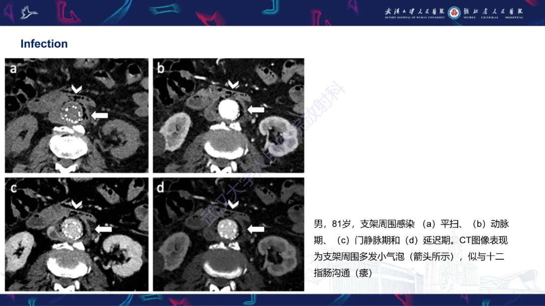 影像PPT - 【PPT】腹主动脉瘤EVAR术后并发症CT评估-10