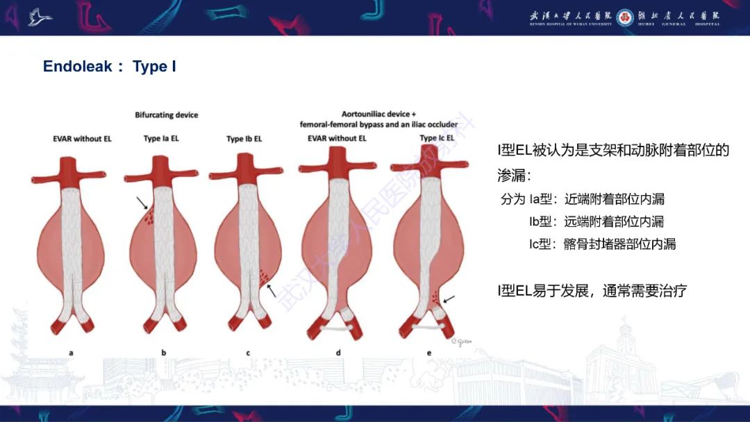 影像PPT - 【PPT】腹主动脉瘤EVAR术后并发症CT评估-12