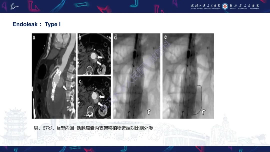 影像PPT - 【PPT】腹主动脉瘤EVAR术后并发症CT评估-13
