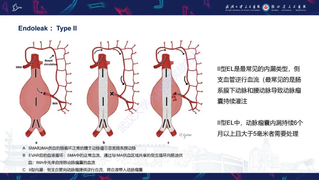 影像PPT - 【PPT】腹主动脉瘤EVAR术后并发症CT评估-14