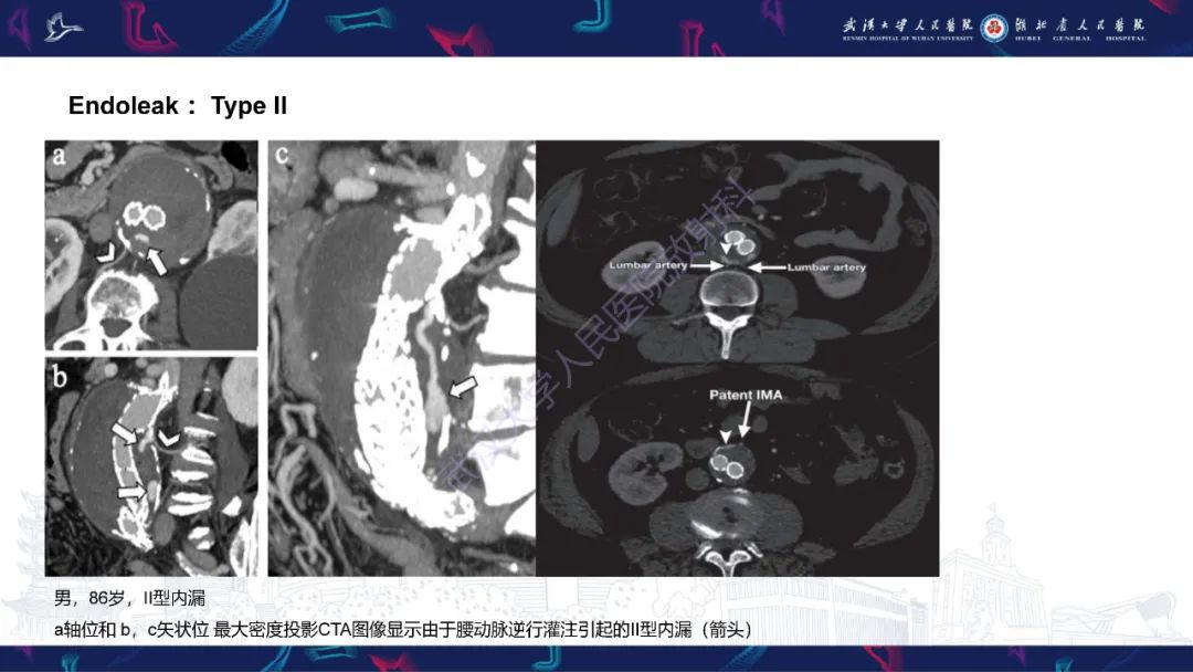 影像PPT - 【PPT】腹主动脉瘤EVAR术后并发症CT评估-15