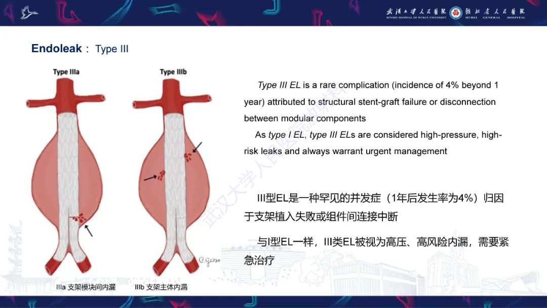 影像PPT - 【PPT】腹主动脉瘤EVAR术后并发症CT评估-16