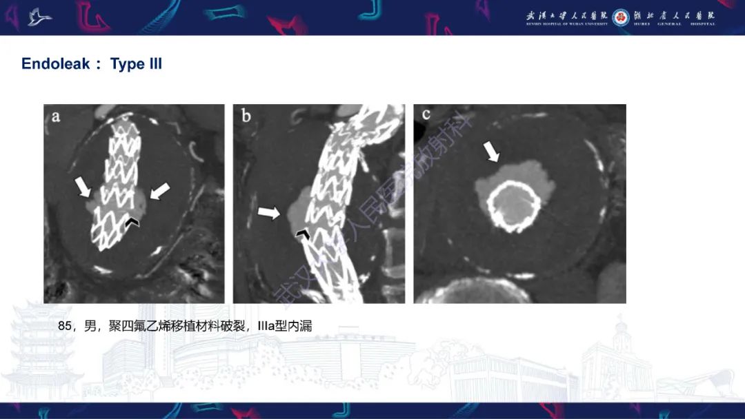 影像PPT - 【PPT】腹主动脉瘤EVAR术后并发症CT评估-18