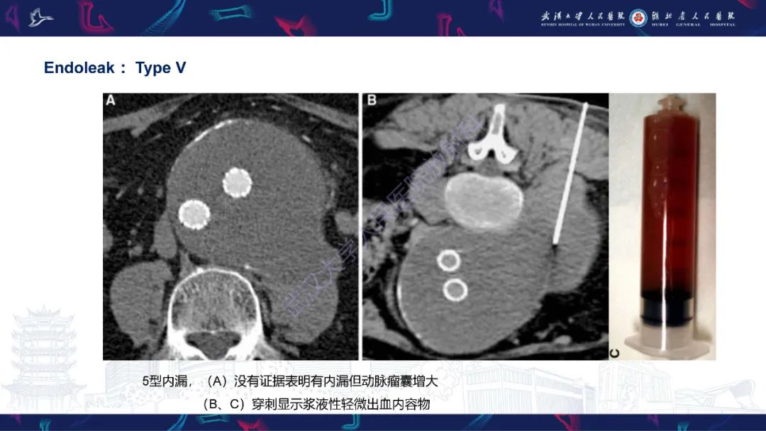 影像PPT - 【PPT】腹主动脉瘤EVAR术后并发症CT评估-22