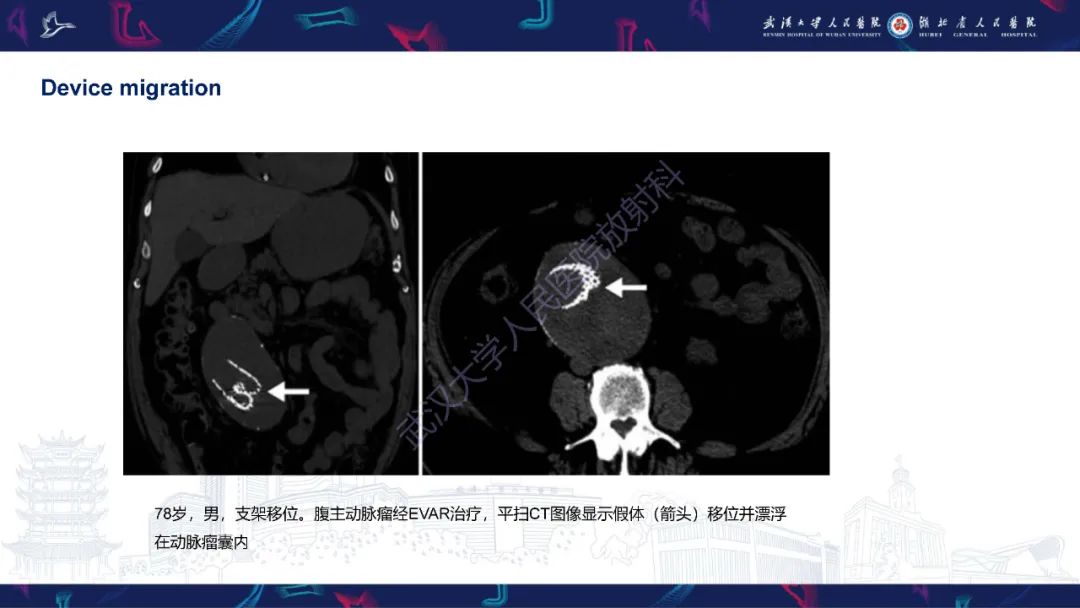 影像PPT - 【PPT】腹主动脉瘤EVAR术后并发症CT评估-24