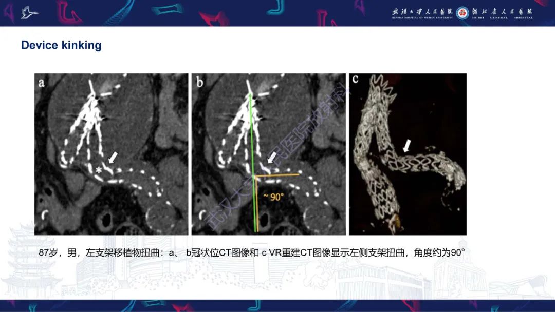 影像PPT - 【PPT】腹主动脉瘤EVAR术后并发症CT评估-26