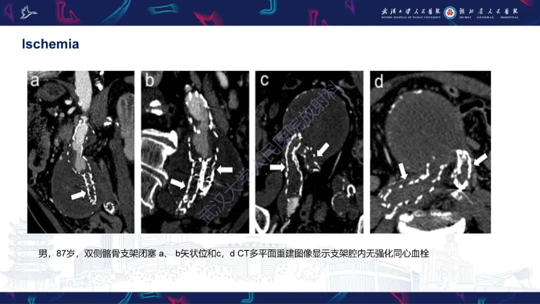 影像PPT - 【PPT】腹主动脉瘤EVAR术后并发症CT评估-30