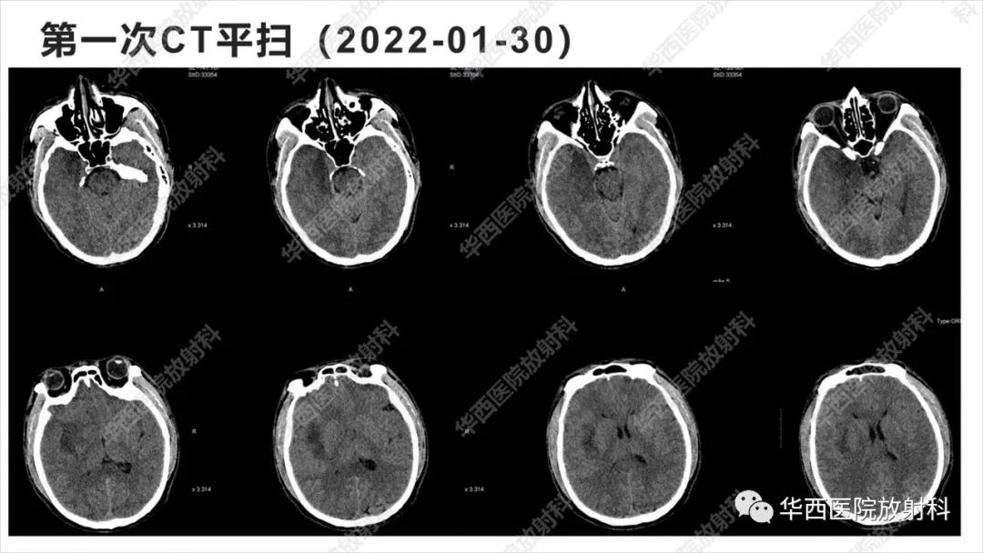 影像PPT - 【病例】出血坏死性病毒脑膜脑炎1例CT及MR影像学表现和鉴别诊断-4