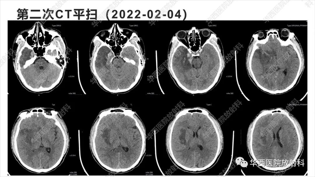 影像PPT - 【病例】出血坏死性病毒脑膜脑炎1例CT及MR影像学表现和鉴别诊断-5