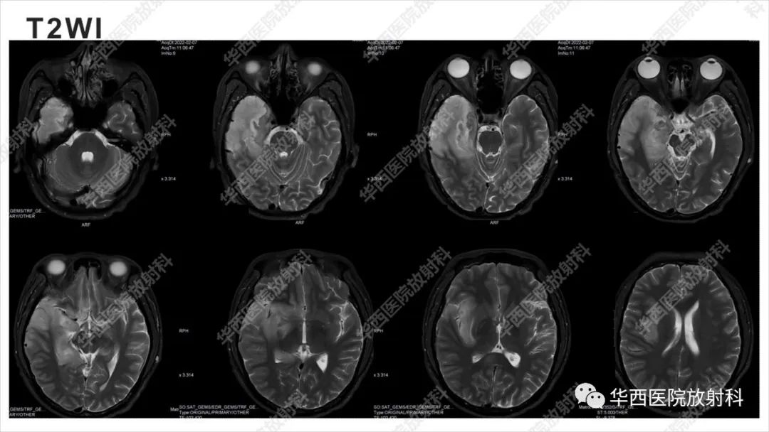 影像PPT - 【病例】出血坏死性病毒脑膜脑炎1例CT及MR影像学表现和鉴别诊断-6