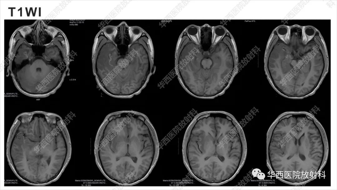 影像PPT - 【病例】出血坏死性病毒脑膜脑炎1例CT及MR影像学表现和鉴别诊断-7