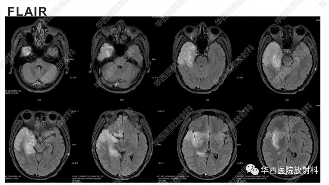 影像PPT - 【病例】出血坏死性病毒脑膜脑炎1例CT及MR影像学表现和鉴别诊断-8