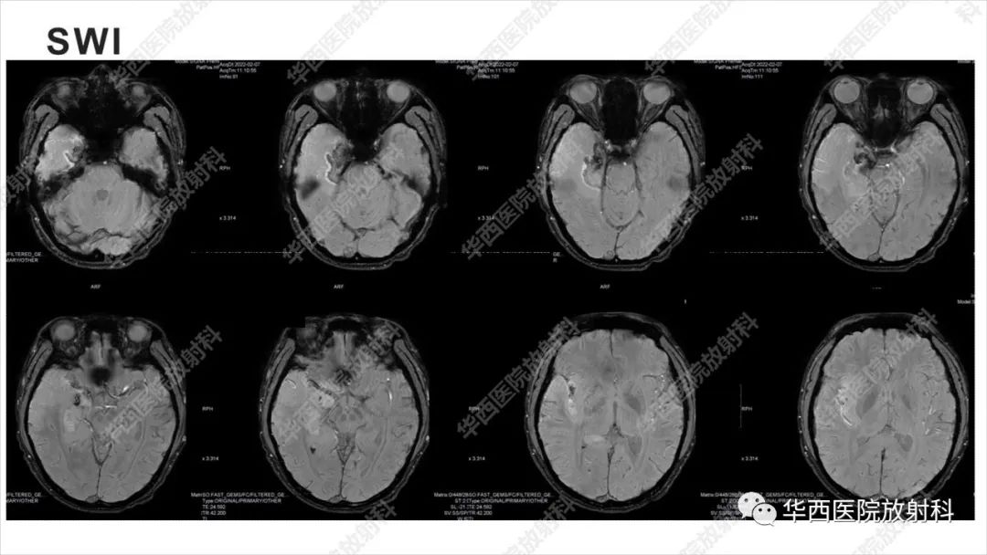 影像PPT - 【病例】出血坏死性病毒脑膜脑炎1例CT及MR影像学表现和鉴别诊断-10