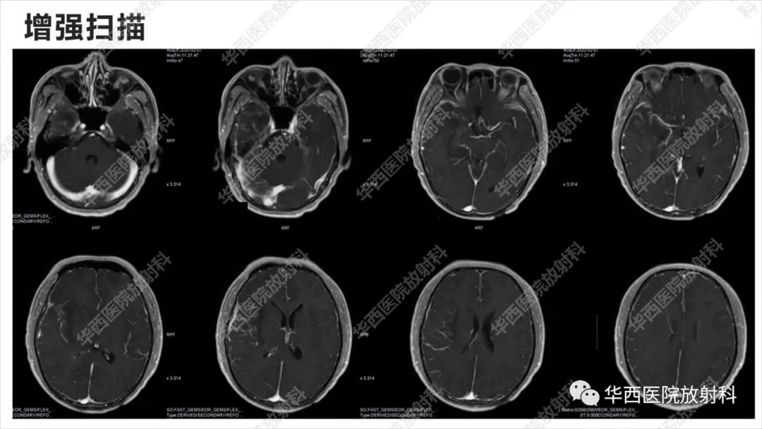 影像PPT - 【病例】出血坏死性病毒脑膜脑炎1例CT及MR影像学表现和鉴别诊断-11