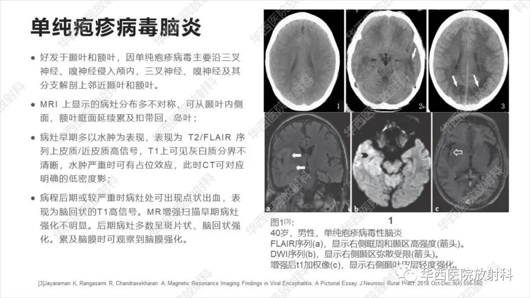 影像PPT - 【病例】出血坏死性病毒脑膜脑炎1例CT及MR影像学表现和鉴别诊断-17