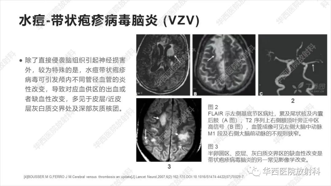影像PPT - 【病例】出血坏死性病毒脑膜脑炎1例CT及MR影像学表现和鉴别诊断-18