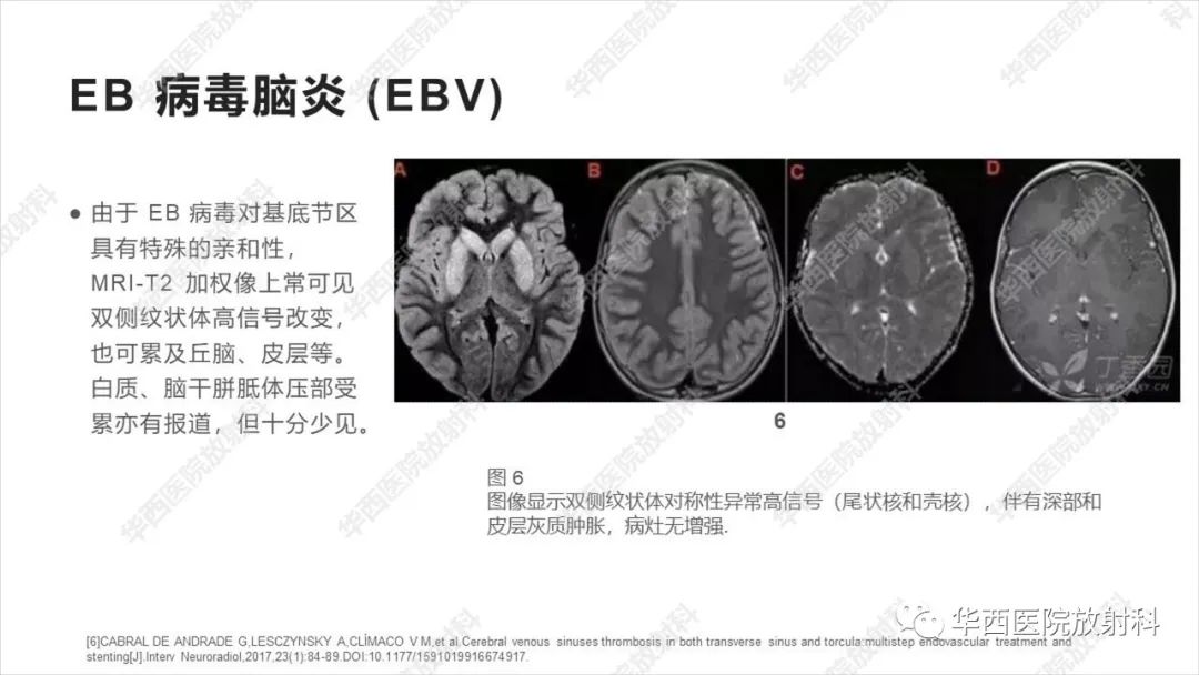 影像PPT - 【病例】出血坏死性病毒脑膜脑炎1例CT及MR影像学表现和鉴别诊断-20