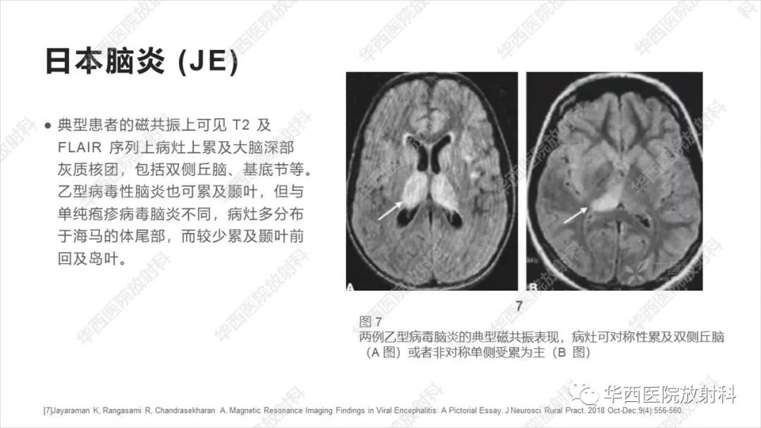 影像PPT - 【病例】出血坏死性病毒脑膜脑炎1例CT及MR影像学表现和鉴别诊断-21