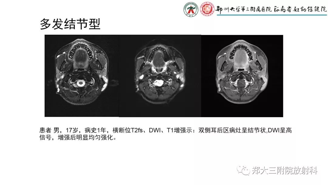 影像PPT - 【PPT】木村病(kimura disease)临床特征及MR表现-7