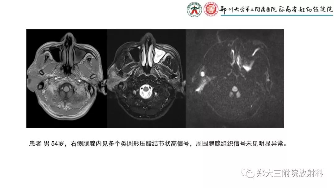 影像PPT - 【PPT】木村病(kimura disease)临床特征及MR表现-8