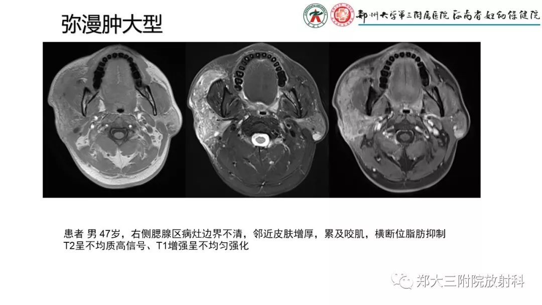 影像PPT - 【PPT】木村病(kimura disease)临床特征及MR表现-9