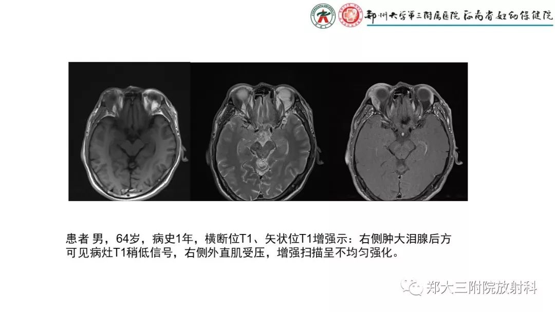 影像PPT - 【PPT】木村病(kimura disease)临床特征及MR表现-12