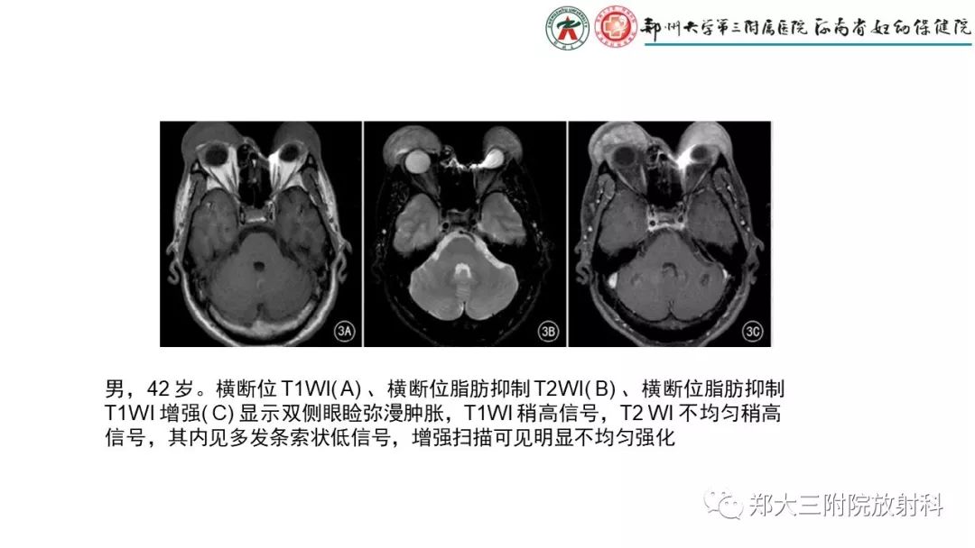 影像PPT - 【PPT】木村病(kimura disease)临床特征及MR表现-13