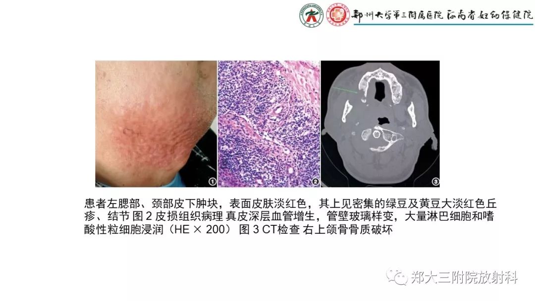 影像PPT - 【PPT】木村病(kimura disease)临床特征及MR表现-14