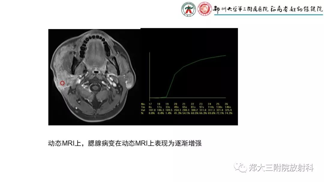 影像PPT - 【PPT】木村病(kimura disease)临床特征及MR表现-10