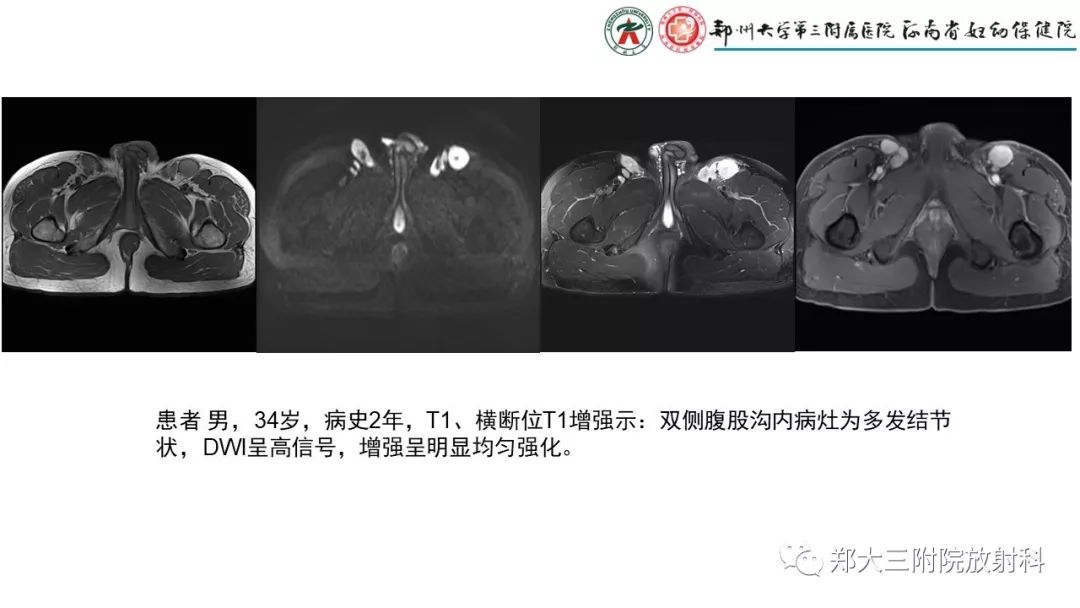 影像PPT - 【PPT】木村病(kimura disease)临床特征及MR表现-16