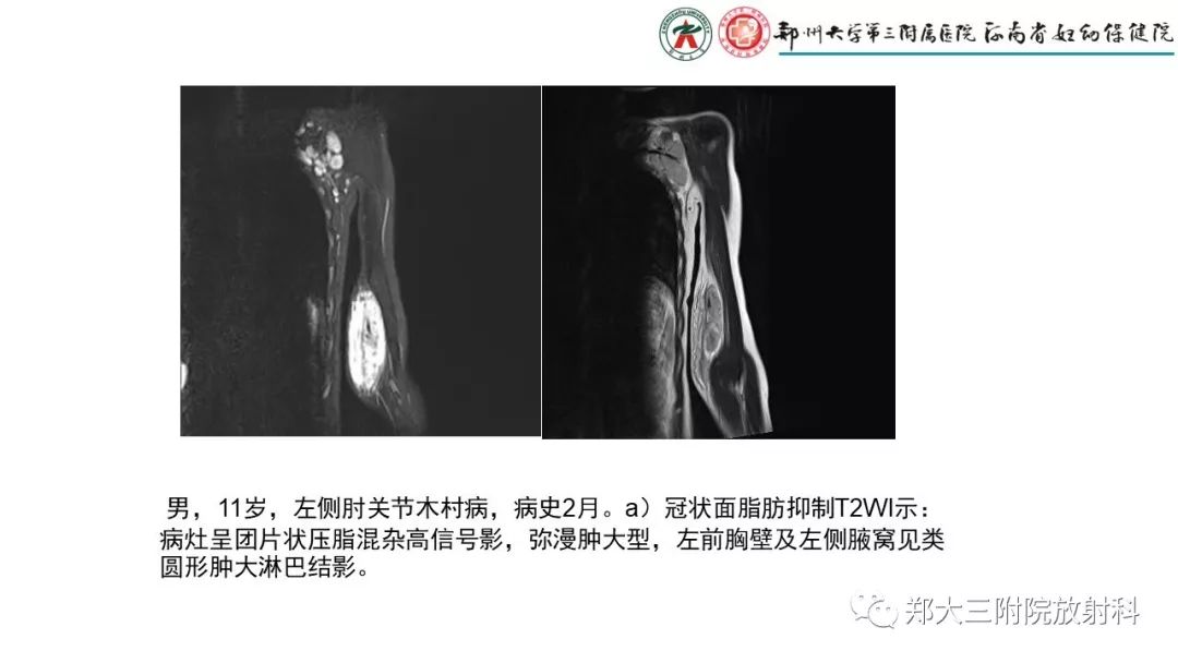 影像PPT - 【PPT】木村病(kimura disease)临床特征及MR表现-17