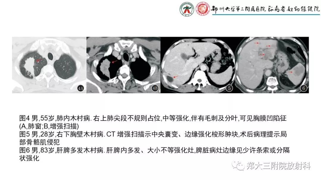 影像PPT - 【PPT】木村病(kimura disease)临床特征及MR表现-18