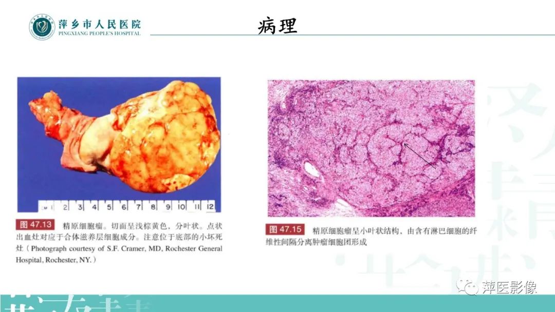 影像PPT - 【PPT】睾丸精原细胞瘤-6