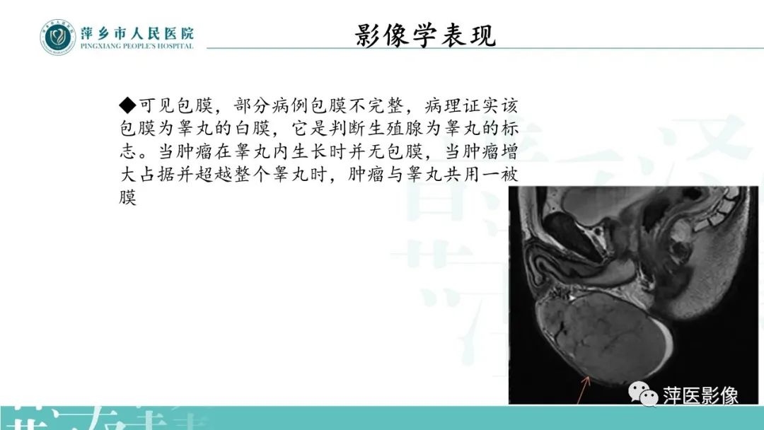 影像PPT - 【PPT】睾丸精原细胞瘤-9