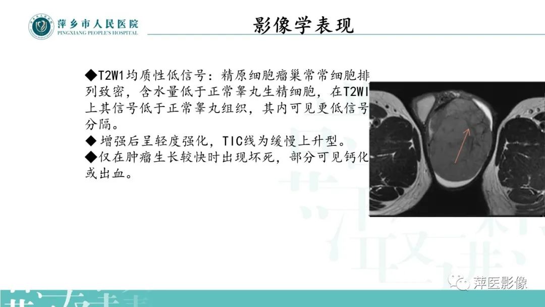 影像PPT - 【PPT】睾丸精原细胞瘤-8