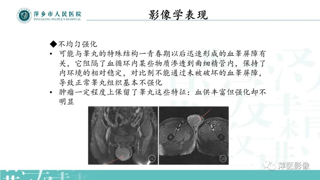 影像PPT - 【PPT】睾丸精原细胞瘤-10