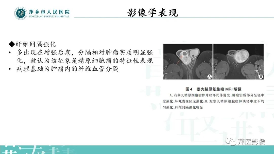 影像PPT - 【PPT】睾丸精原细胞瘤-11