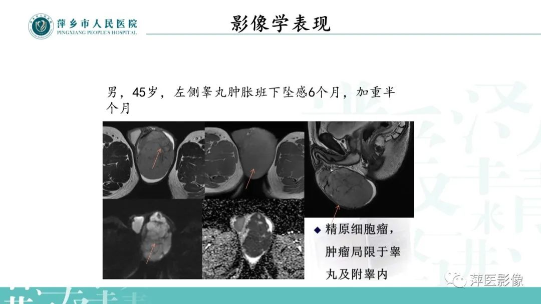 影像PPT - 【PPT】睾丸精原细胞瘤-12
