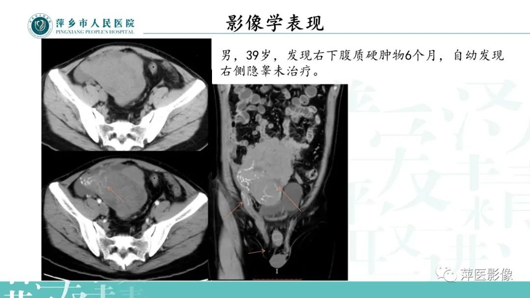影像PPT - 【PPT】睾丸精原细胞瘤-15